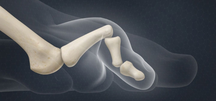 Forefoot/Midfoot Reconstruction