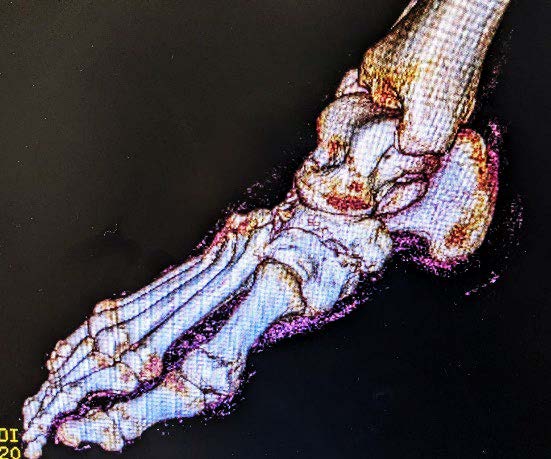 3D Scan of Foot and Ankle