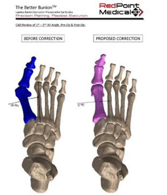 RedPoint Medical 3D - The Better Bunion™