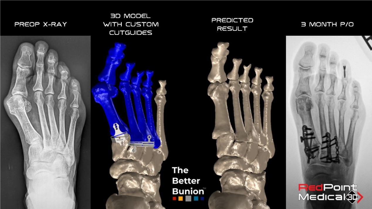 Right to left: The Better Bunion: Preop X-ray, 3D Model with Custom Cutguides, Predicted Result, 3 Month P/O; RedPoint Medical 3D