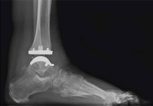 Xray of an Exactech Vantage Total Ankle Replacement