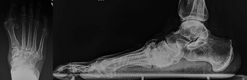 Preoperative radiographs. Note the significant loss of integrity of the midfoot bone stock.