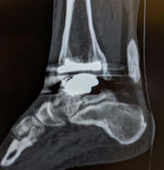 CT scan demonstrating a talar fracture